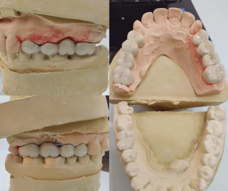 Teeth whitening cost in mumbai